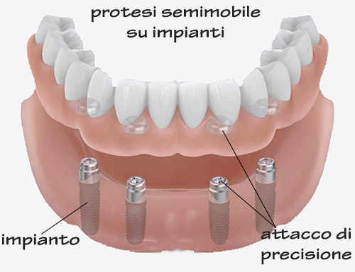 protesi dentale semimobile
